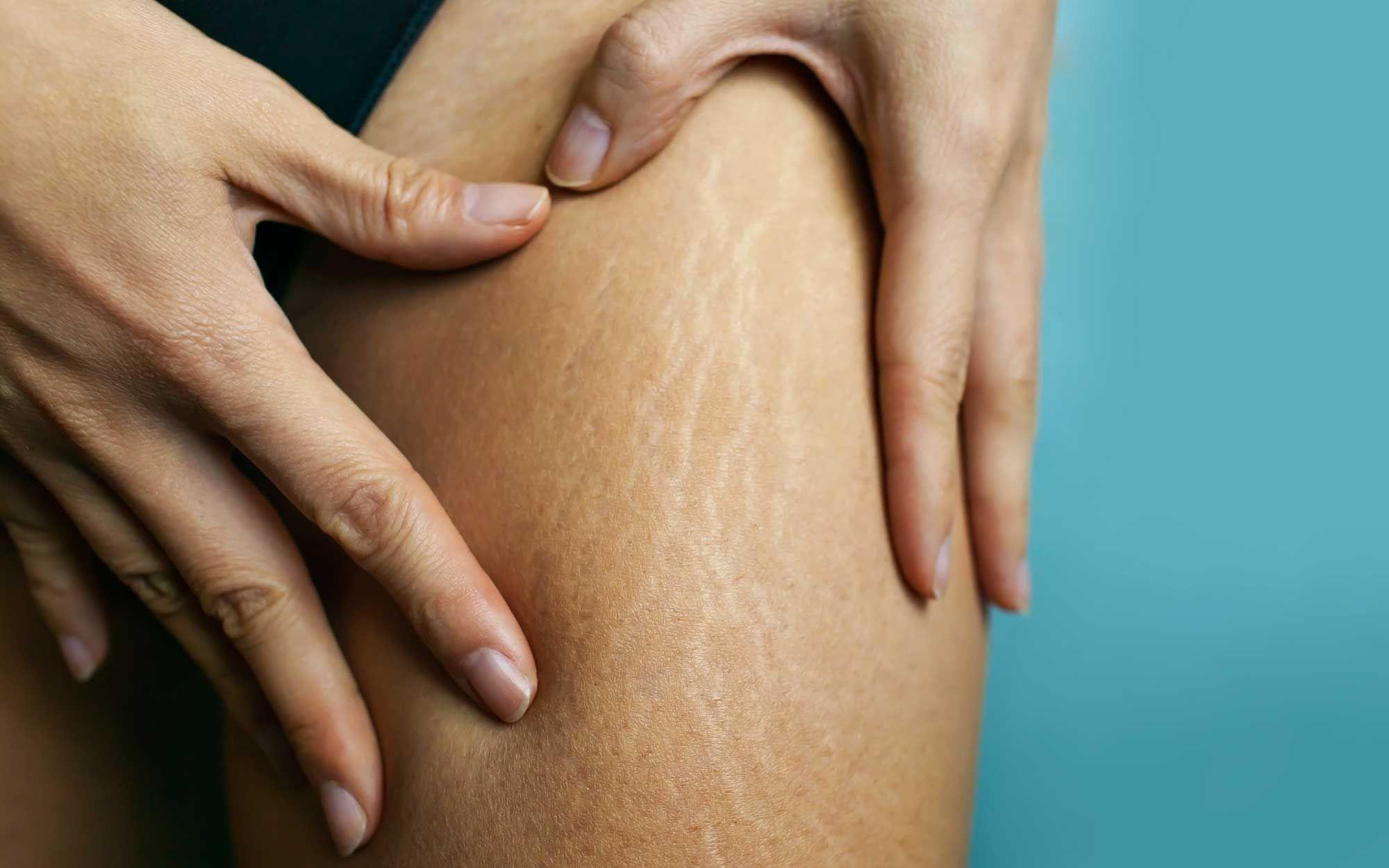 What Does Raised Stretch Marks Mean